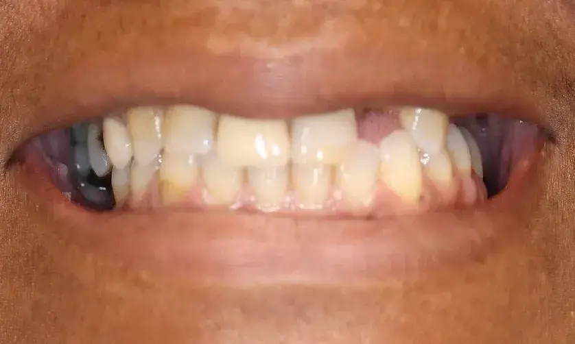 A close-up of a person's mouth showing misaligned and discolored teeth.