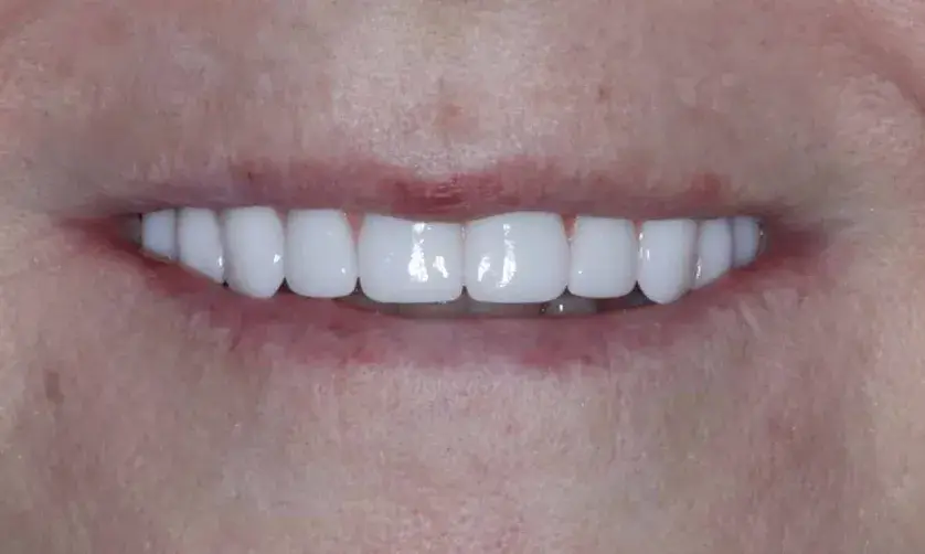 Close-up of a person smiling, showing clean, white teeth.