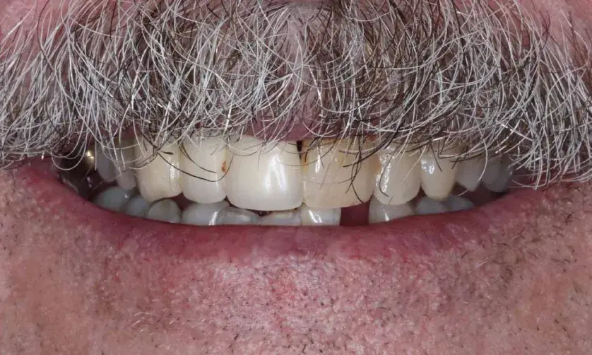 A close-up of a person's mouth showing teeth and a gray mustache.
