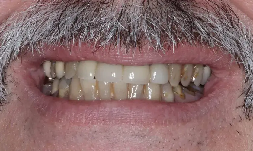 A mouth with visible teeth and a mustache above the upper lip.